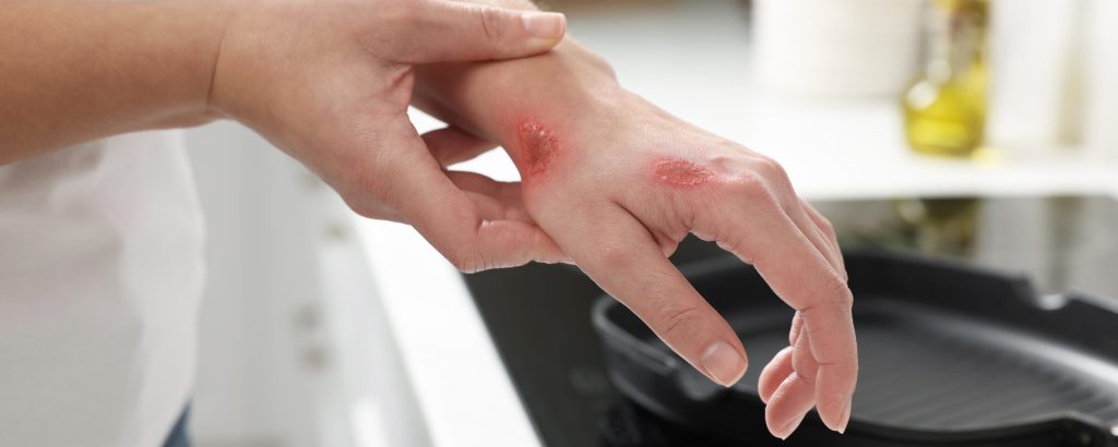 Queimaduras em ambiente doméstico: CFQ alerta para os riscos de acidentes e cuidados preventivos